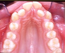 Πριν τη θεραπεία-στενό άνω οδοντικό τόξο